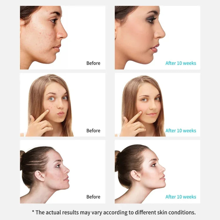 Xpreen Dispositivo Facial de Beleza Recarregável para Limpeza de Poros com Ecrã LED e 4 Sondas, XPRE111