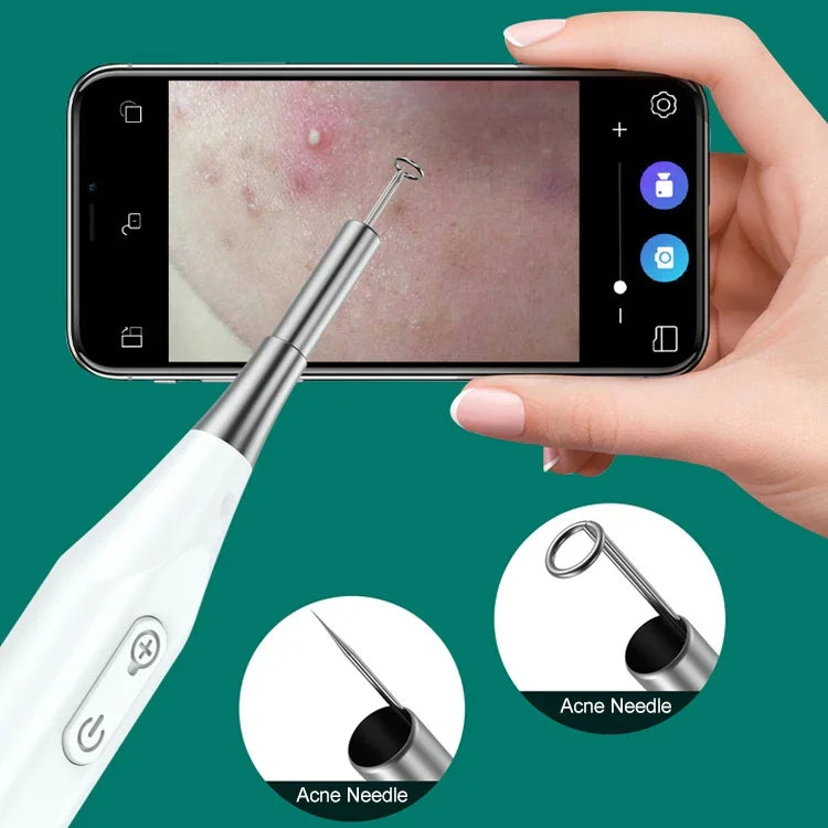 Endoscópio Supereyes Y009 Visual para Limpeza de Acne, Espelho Microscópico de Ampliação para Ouvido, Y009