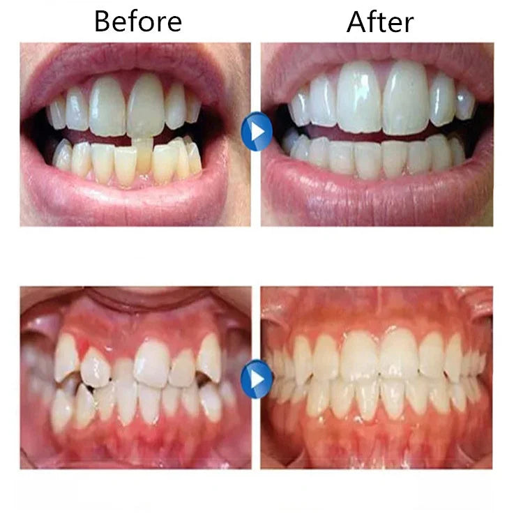 Aparelho Ortodôntico de Silicone Simulador de Aparelhos Dentários, Anti-Molares para Uso Noturno, Primeira, Segunda e Terceira Fase