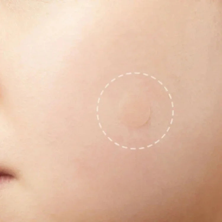 Conjunto de 3 Ferramentas para Tratamento de Acne, Cicatrizes de Acne e Borbulhas, Adesivos
