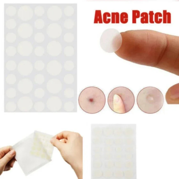 Conjunto de 3 Ferramentas para Tratamento de Acne, Cicatrizes de Acne e Borbulhas, Adesivos
