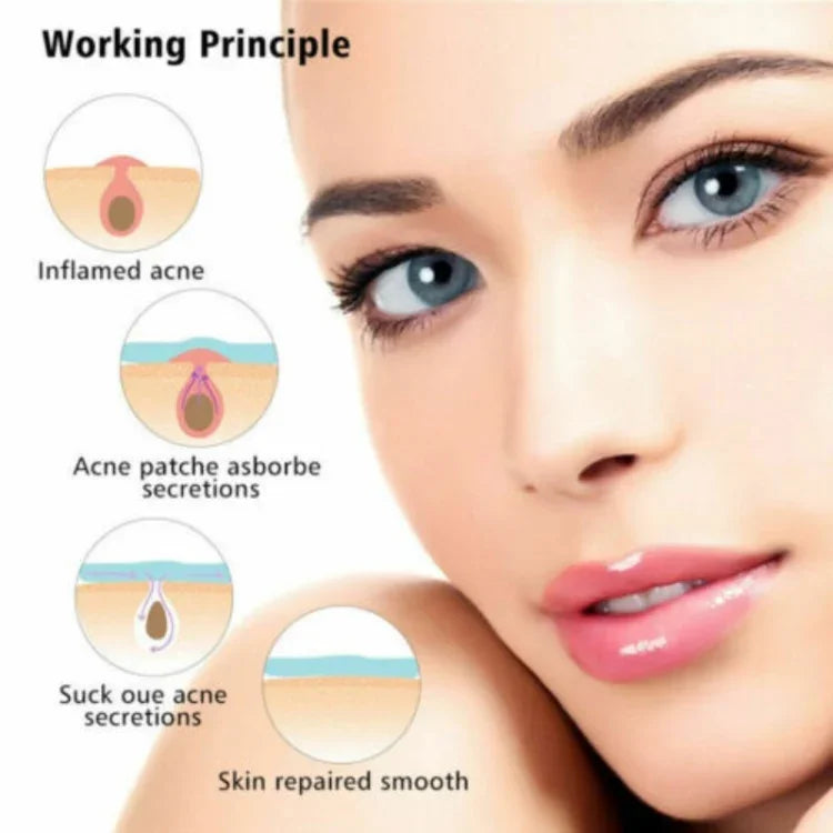 Conjunto de 3 Ferramentas para Tratamento de Acne, Cicatrizes de Acne e Borbulhas, Adesivos