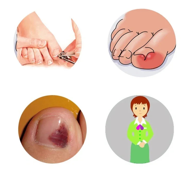 Ortopedia para Unhas dos Pés 12 em 1 para Unhas Encravadas