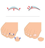 Ortopedia para Unhas dos Pés 12 em 1 para Unhas Encravadas