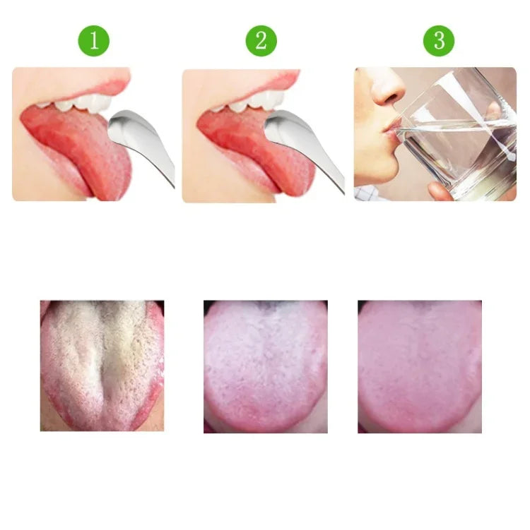 Limpador de Língua para Mau Hálito, Escova de Limpeza em Aço Inoxidável, Raspador de Língua + Conjunto de Duas Peças (Dourado Rosa), Raspador de Língua + Conjunto de Duas Peças (Prateado), Raspador de Língua + Conjunto de Duas Peças (Dourado Rosa)