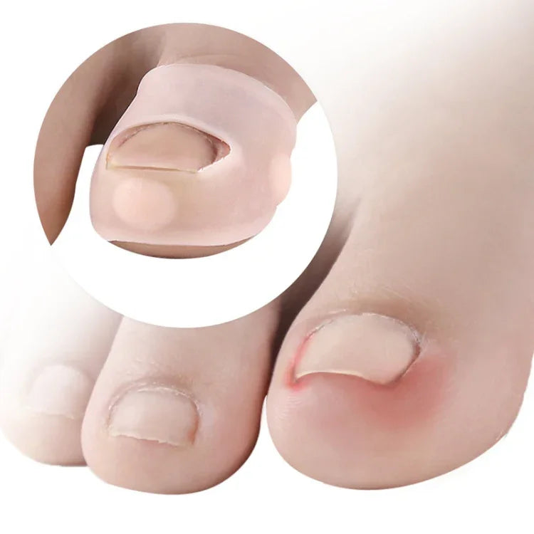 Correção para Unhas Encravadas para Evitar que as Unhas Cresçam na Carne, Tamanho Único