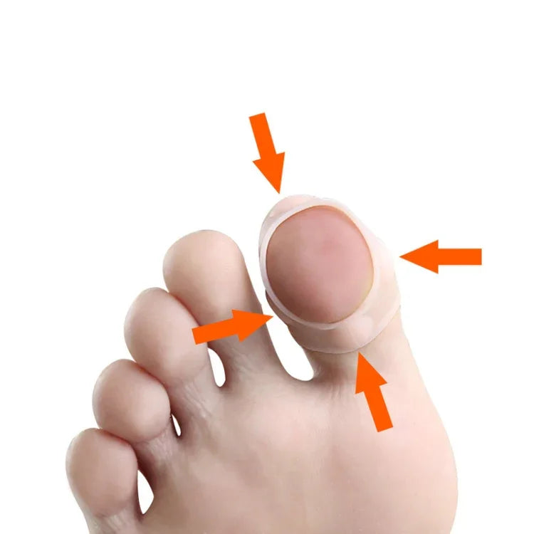 Correção para Unhas Encravadas para Evitar que as Unhas Cresçam na Carne, Tamanho Único
