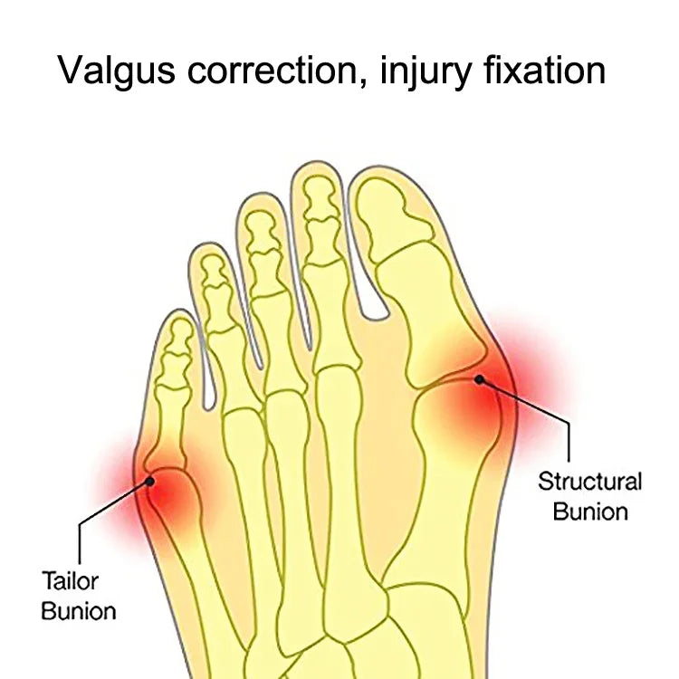1 Par de Correctores de Joanete para Dedo Grande do Pé, Usável com Sapatos, Divisor Confortável, S, L