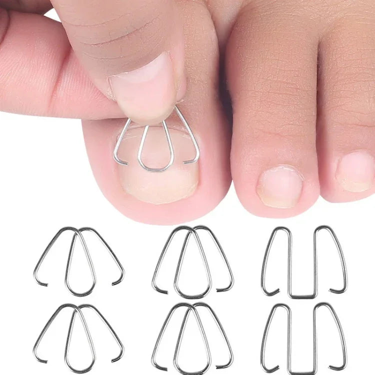 6pcs /Caixa Ganchos Ortopédicos para Unhas com Inserção de Fio Ortopédico